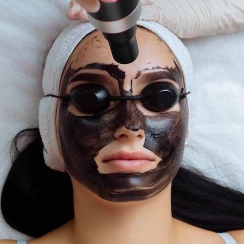 Carbon facial treatment using a laser handpiece