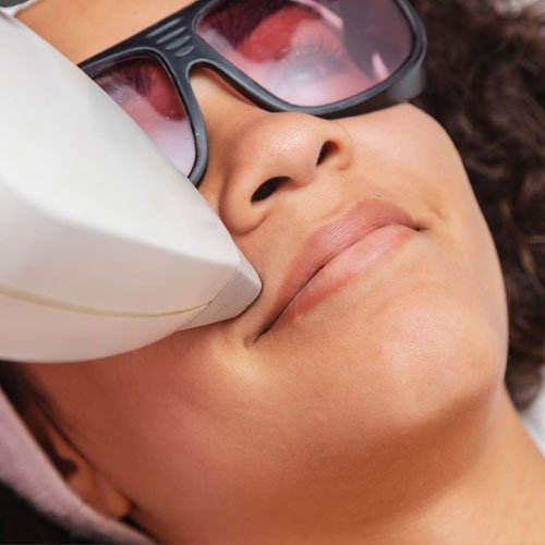 A clinician treating the upper lip with a laser handpiece