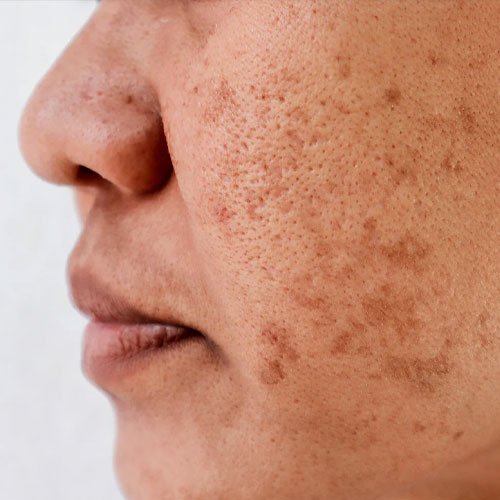 Close-up of facial pigmentation and uneven skin tone